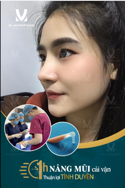 Dáng mũi “ gây thương nhớ “ tại Dr Minh Phạm sau 1 tháng