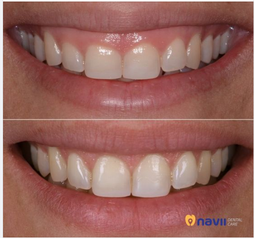 Đối với những người bị cười hở lợi, đây chắc hẳn là một khuyết điểm khiến họ cảm thấy mất tự tin, làm cho nụ cười thiếu đi sự duyên dáng, hài hoà