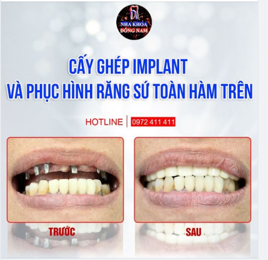 Hoàn thành trồng răng Implant trước Tết