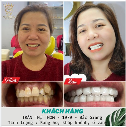 Hoàn thành xong ca thẩm mỹ 18 răng sứ cao cấp cho chị khách hàng cực xinh đến từ Bắc Giang .