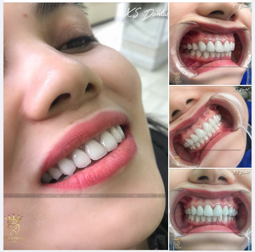 Khách hàng tái khám sau hơn 1 năm làm trọn bộ 20 răng Ceramill cao cấp tại nha khoa XS Dental .