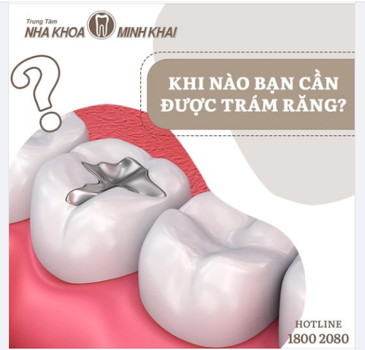 KHI NÀO BẠN CẦN ĐƯỢC TRÁM RĂNG ​​​​​​​