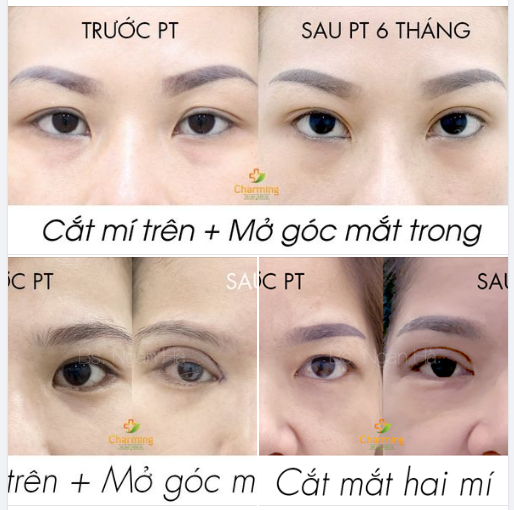 Một vài hình ảnh Cắt mí mắt tại Thẩm mỹ viện Charming tập hợp lại cho