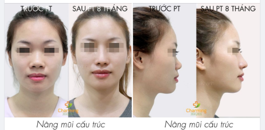 Mũi thấp, cánh mũi to là đặc điểm bạn có thể tìm thấy ở nhiều người Việt, hay nói cách khác thì đây là điểm chung về dáng mũi của người Á Đông chúng ta.