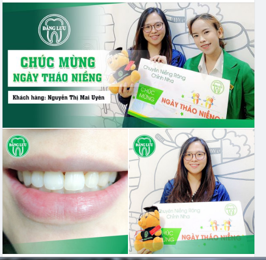 MỪNG NỤ CƯỜI MỚI Chúc mừng bạn Nguyễn Thị Mai Uyên đã Niềng răng thành công tại Nha Khoa Đăng Lưu!