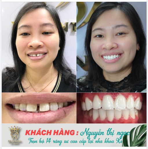 Nha khoa hoàn thành xong bộ 14 răng sứ cao cấp cho khách hàng đến từ Hà Đông Hà Nội