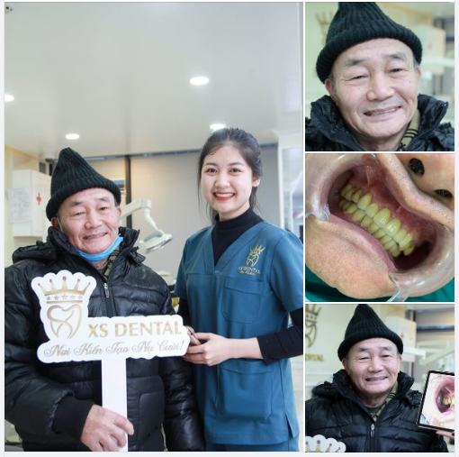 Nha khoa hoàn thành xong trọn bộ răng sứ thẩm mỹ 19 răng sứ cao cấp cho 1 khách hàng lởn tuổi tại nha khoa .