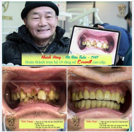 Nha khoa hoàn thành xong trọn bộ răng sứ thẩm mỹ 19 răng sứ cao cấp cho 1 khách hàng lởn tuổi tại nha khoa .