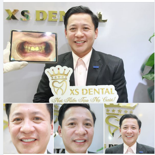 Nha khoa XS hoàn thành xong bộ 20 răng sứ cao cấp tại nha khoa .