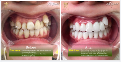 Nha khoa XS Vừa hoàn thành xong ca thẩm mỹ 16 răng sứ Ceramill cao cấp cho chị khách hàng Thảo Nhi .