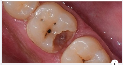 Răng hàm sâu có nên bọc răng sứ không?