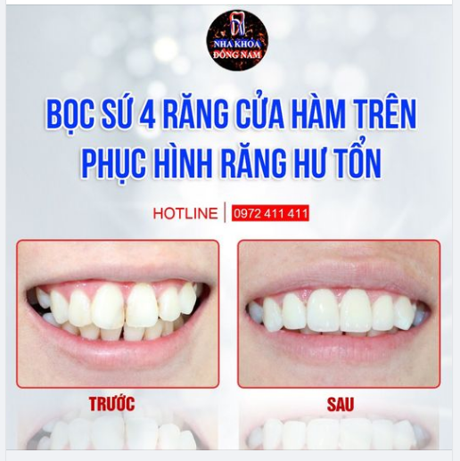 SÂU KẼ RĂNG CỬA ẢNH HƯỞNG ĐẾN ĂN NHAI VÀ THẨM MỸ