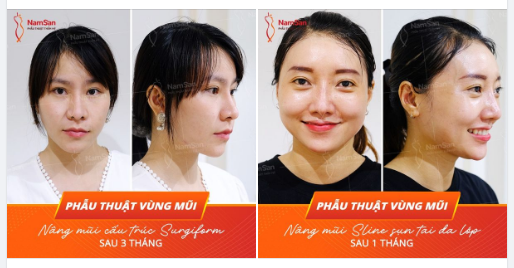 Sau phẫu thuật vùng mũi, 10,000+ khách hàng của Nam San vui vẻ chia sẻ cảm nhận