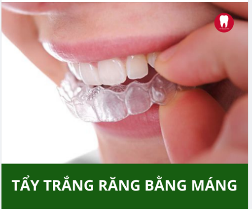 TẨY TRẮNG RĂNG BẰNG MÁNG Tẩy trắng răng bằng máng là gì?