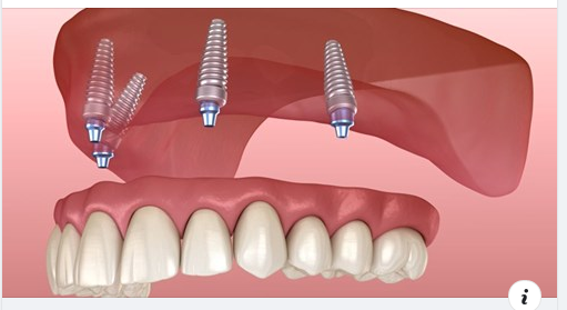 Ưu điểm nổi bật của phương pháp trồng răng implant all on 4 ​​​​​​​