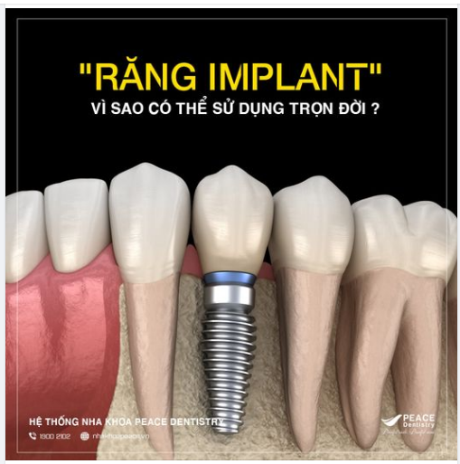 Vì sao “răng Implant có thể sử dụng trọn đời”