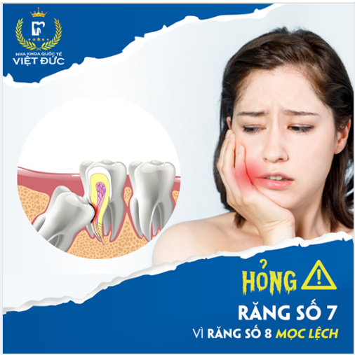 Có cần phải gắp răng số 8 ra nếu nó đâm vào răng số 7?
