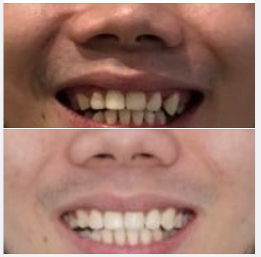 Một trường hợp niềng răng thất bại tại nơi khác, điều trị lại bằng Invisalign tại nha khoa Lan Anh.