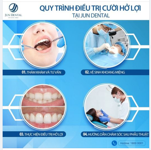 ​​​​​​​Quy trình điều trị cười hở lợi tại Nha khoa Jun Dental