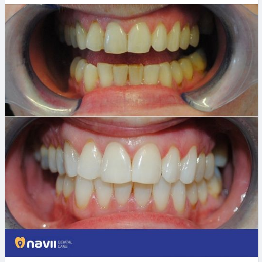 Tẩy răng trắng sáng Tự tin cười đón xuân sang