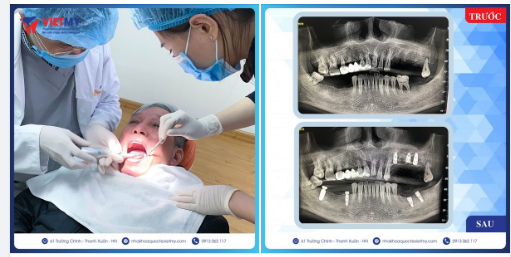 Tiếp tục là những ca trồng răng implant cho quý khách hàng tại nha khoa quốc tế Việt Mỹ.