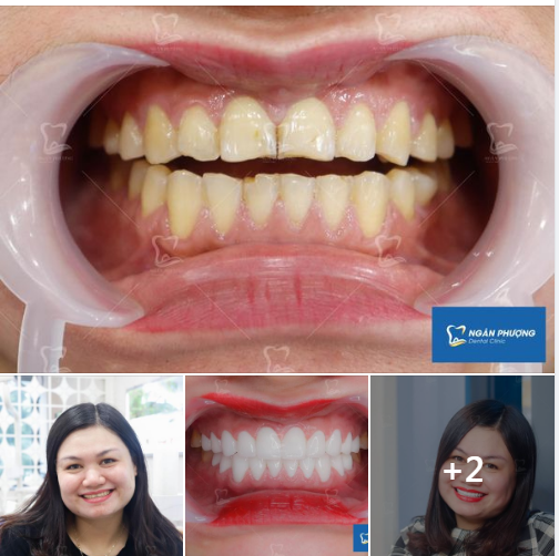 Case răng mòn rìa cắn, nhiễm vàng và tụt lợi được điều trị bằng làm răng sứ thẩm mỹ.