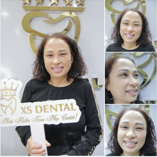 Cô Khách hàng tái khám sau hơn 1 năm làm 20 răng sứ thẩm mỹ tại nha khoa  Xs Dental 