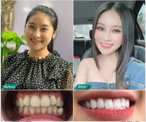 Hotgirl Bùi Hồng Anh nổi tiếng  tiktok vừa hoàn thành xong bộ 16 răng sứ thẩm mỹ  Ceramil tại nha khoa Xs Dental .