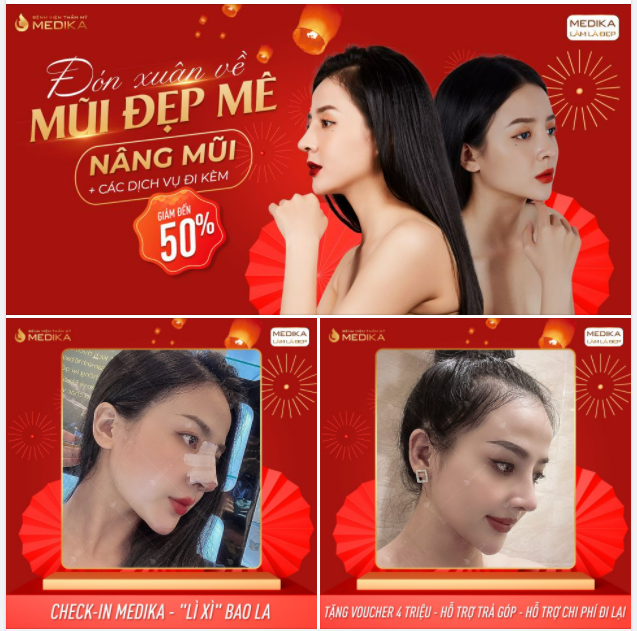 MŨI CAO XINH ​​​​​​​ ĐẸP MỌI KHUNG HÌNH