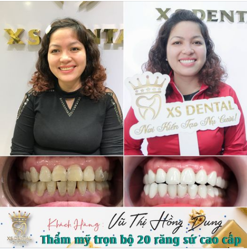 Nha khoa hoàn thành lắp xong bộ thẩm mỹ 20 răng sứ cao cấp cho chị khách hàng tới từ Thanh Trì - Hà Nội .