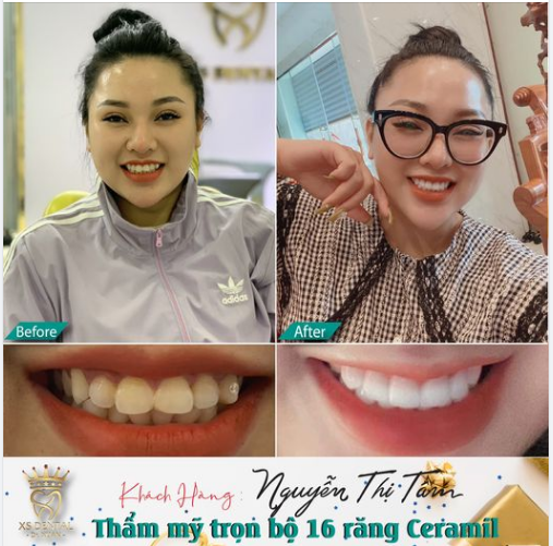 Nha khoa xs hoàn thành xong bộ 16 răng sứ  Ceramil cho chị khách hàng xinh gái .
