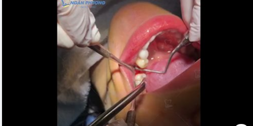 Quy trình trồng răng implant tại nha khoa Ngân Phượng do BSCK I Nguyễn Minh Giang thực hiện.