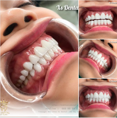 Thẩm mỹ răng sứ , chọn sao cho được dòng răng sứ chuẩn đẹp mới là xu hướng