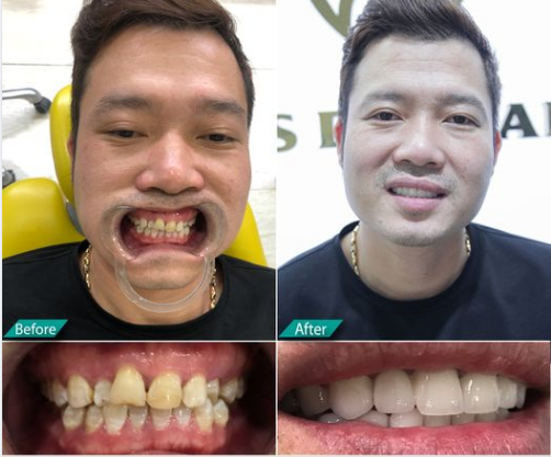 Tình trạng răng trước đây anh kiên đang gặp phải vấn đề răng 1.1 1.2 bị mẻ , màu sắc răng xấu và có cao răng