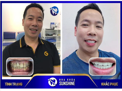 Anh khách hàng mới thực hiện xong dịch vụ bọc 20 răng sứ Ziconia HT tại nha khoa Sunshine