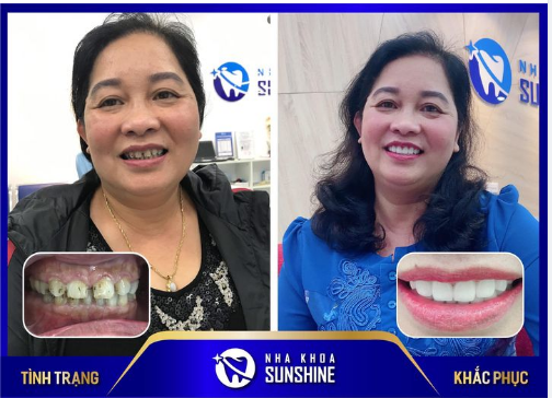 Cô khách hàng từ Lạng Sơn đã trở nên rạng rỡ hơn sau khi bọc 20 răng sứ Ceramill