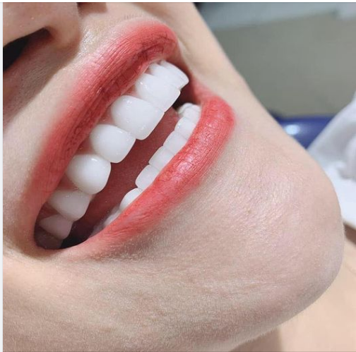 GIẢM GIÁ LÊN ĐẾN 20- 25%cho tất cả các dịch vụ trồng răng sứ