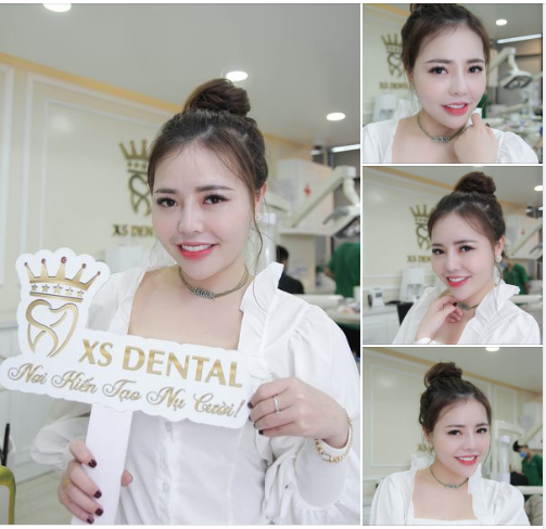 Khách hàng xinh gái trở lại tuổi 18 sau khi làm trọn bộ răng sứ tại nha khoa Xs Dental .