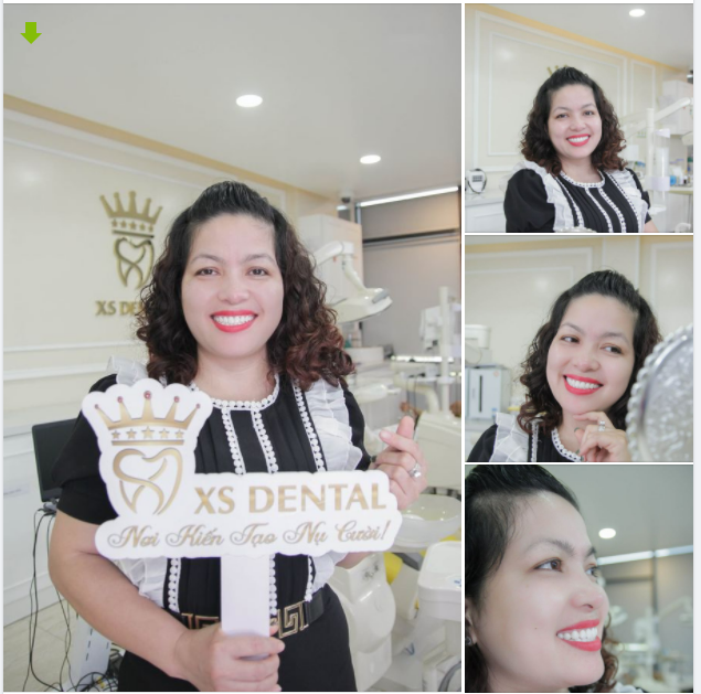 Nha khoa hoàn thành lắp xong bộ thẩm mỹ 20 răng sứ cao cấp cho chị khách hàng tới từ Thanh Trì - Hà Nội .