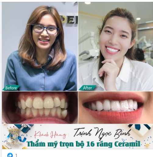 Nha khoa  Xs hoàn thành xong ca thẩm mỹ 16 răng sứ  Ceramil cho bạn khách hàng xinh gái .