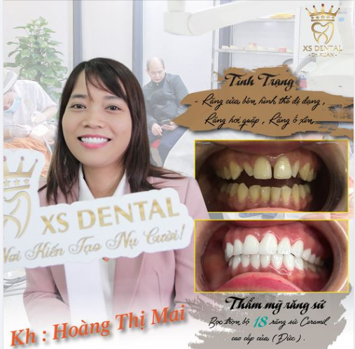 Nha khoa Xs vừa hoàn thành xong ca thẩm mỹ 18 răng sứ  Ceramil cao cấp cho chị khách hàng .
