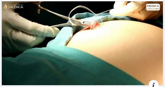 Nhiều chị em chưa sinh muốn thực hiện phẫu thuật kéo núm vú tụt để cải thiện khuyết điểm vòng 1 nhưng lo sợ có thể ảnh hưởng đến tuyến sữa.