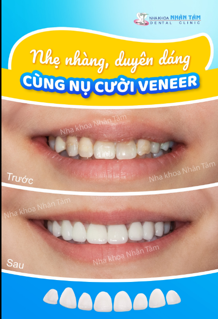 Sở hữu nụ cười đẹp ít xâm lấn răng sẽ trở thành hiện thực với điều trị mặt dán sứ Veneer.