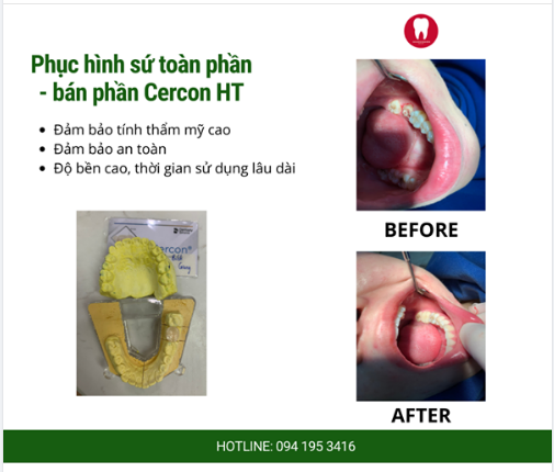 Sử dụng răng toàn sứ Cercon HT đảm bảo được sự an toàn cho sức khỏe răng miệng.
