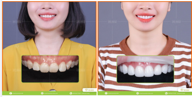 Tiếp tục với 1 ca veneer lên răng là khách hàng ưng ý gắn luôn đến từ team Việt Smile