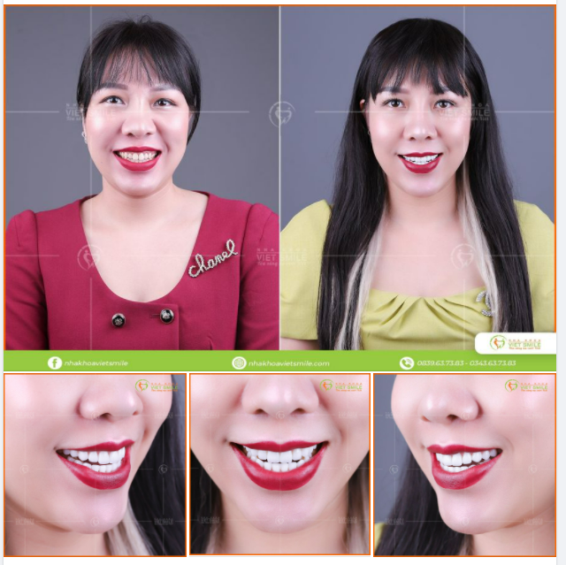 Với mong muốn có một nụ cười đều đẹp, trắng sáng khách hàng nhà Việt Smile đã lựa chọn dịch vụ dán sứ Veneer Lisi Press.