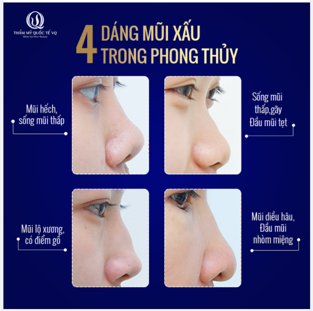 4. Cách Cải Thiện Dáng Mũi Tẹt