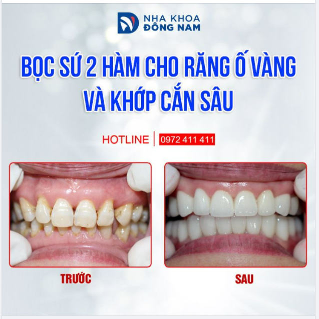 “Bọc răng sứ vẫn giữ được sự tự nhiên, quan trọng hơn là ăn nhai thoải mái và sử dụng lâu dài” là tiêu chí của Nha khoa Đông Nam chúng tôi.