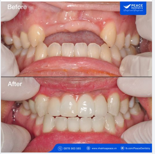 Ca lâm sàng: Cấy ghép 2 Implant khôi phục 4 răng cửa đã mất nhiều năm