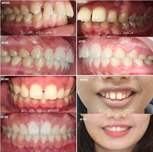 Ca lâm sàng niềng răng chỉnh hô, kết hợp 2 minivis chữa cười hở lợi (không nhổ răng, hoàn thành trong 24 tháng)